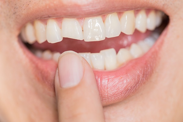 What Can Happen to an Untreated Chipped Tooth