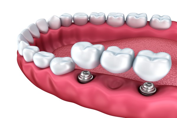 How a Dental Bridge is Secured In Place