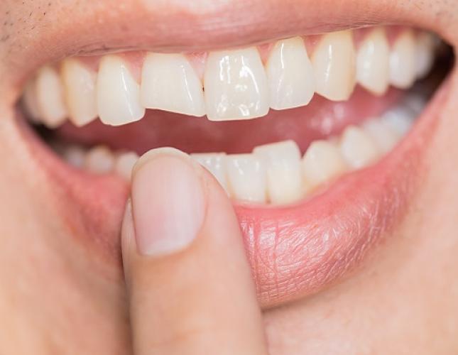 What Can Happen to an Untreated Chipped Tooth