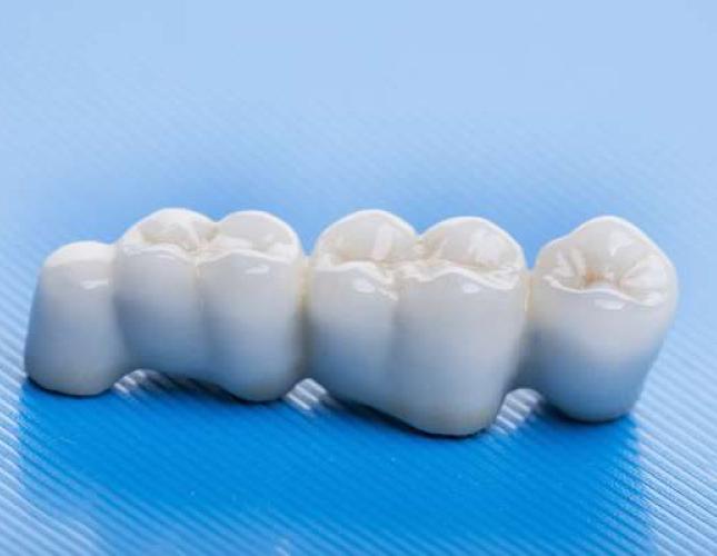 How Many Teeth Can Dental Bridges Replace