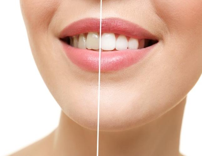 Understanding Professional Teeth Whitening