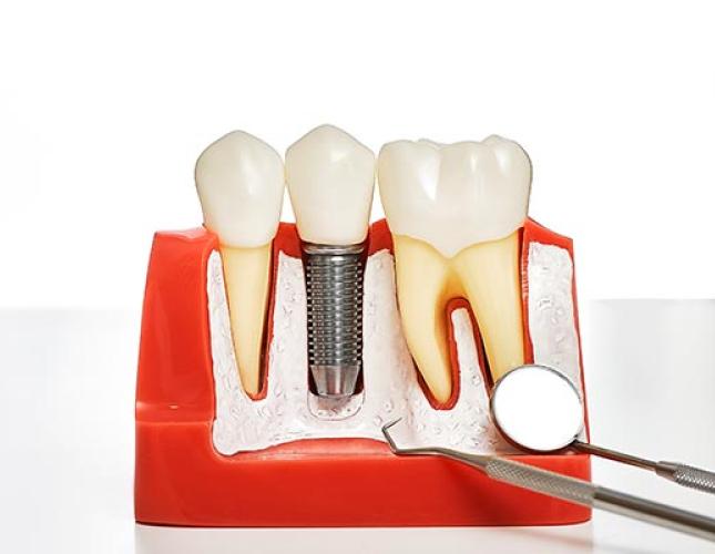 Your Guide to Different Kinds of Dental Implants