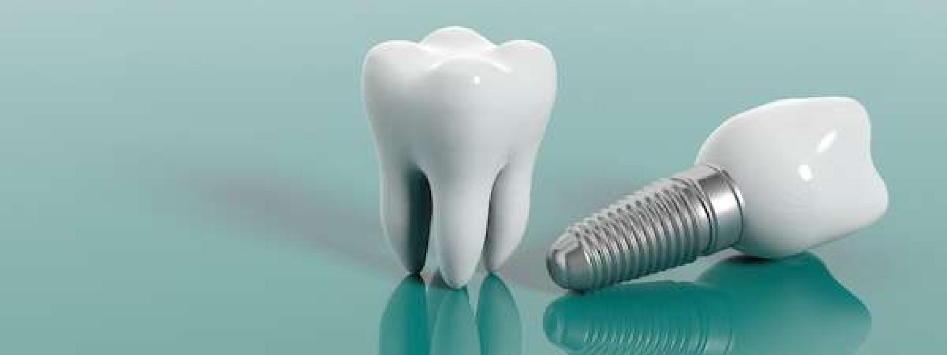 Multiple Teeth Replacement Options